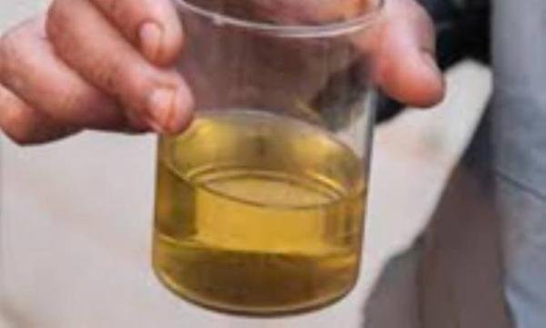 علل تیره شدن رنگ ادرار علل تیره شدن رنگ ادرار